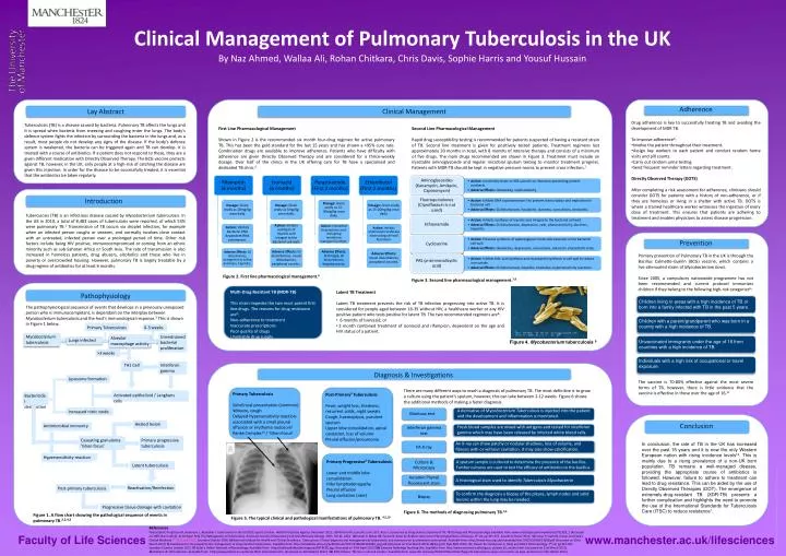 clinical management of pulmonary tuberculosis in the uk