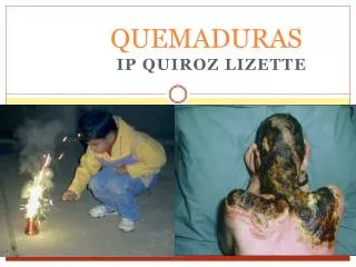 quemaduras