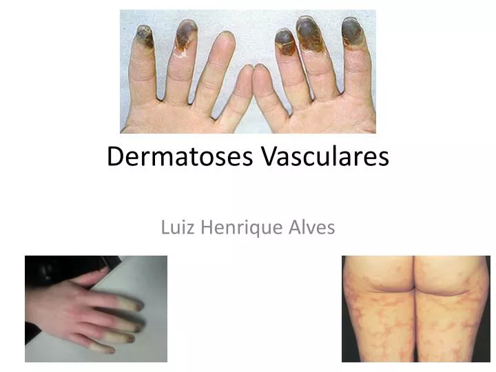 dermatoses vasculares