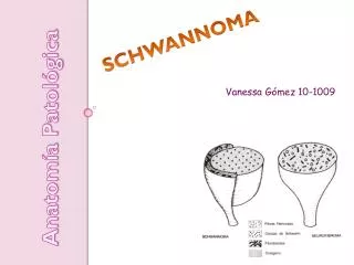 schwannoma