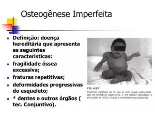 osteog nese imperfeita