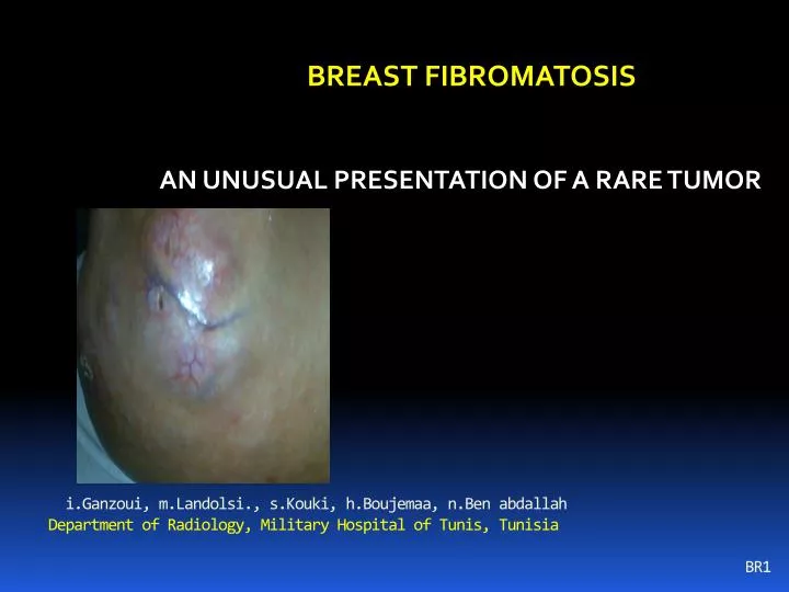 breast fibromatosis an unusual presentation of a rare tumor