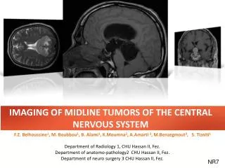 IMAGING OF MIDLINE TUMORS OF THE CENTRAL NERVOUS SYSTEM