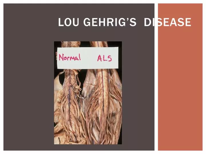 lou gehrig s disease