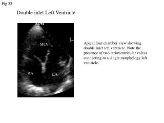 Double inlet Left Ventricle