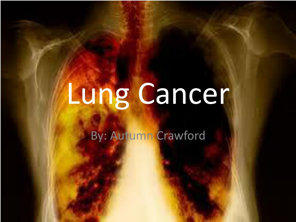 PPT - Lung Cancer PowerPoint Presentation, free download - ID:2353430