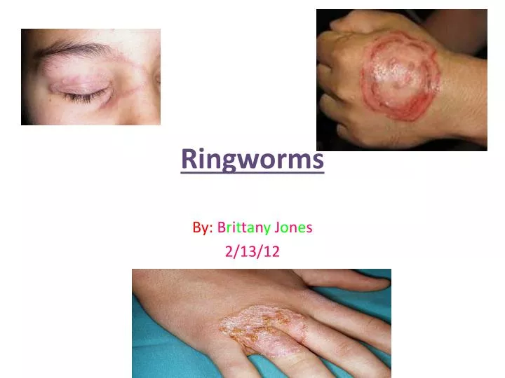 ringworms