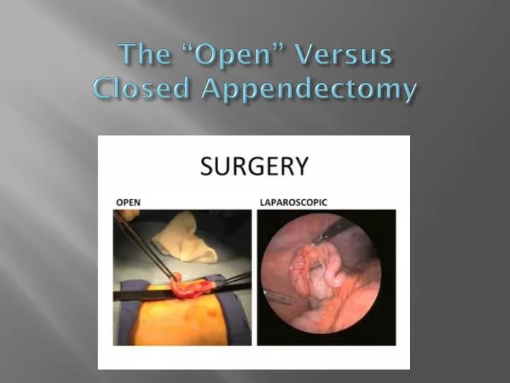 the open versus closed appendectomy