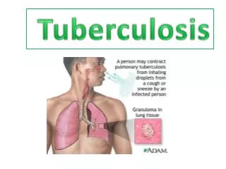 Tuberculosis