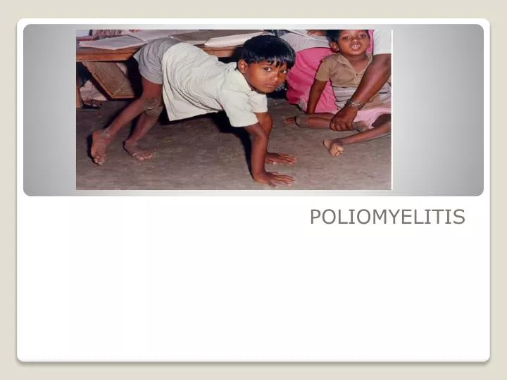 poliomyelitis