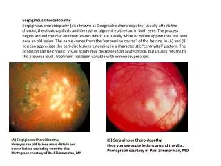 Serpiginous Choroidopathy