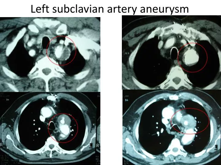 left subclavian artery aneurysm