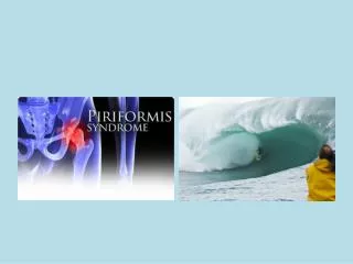 Piriformis Syndrome