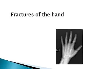 Fractures of the hand