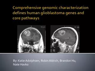 Comprehensive genomic characterization defines human glioblastoma genes and core pathways