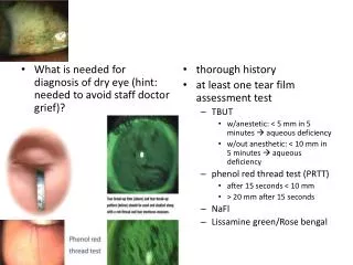 What is needed for diagnosis of dry eye (hint: needed to avoid staff doctor grief)?