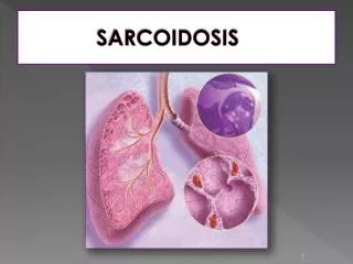 SARCOIDOSIS