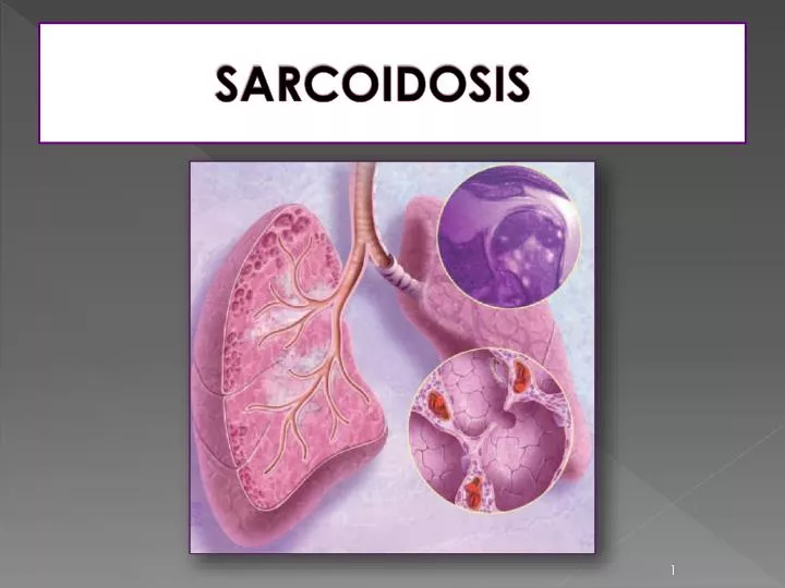 sarcoidosis