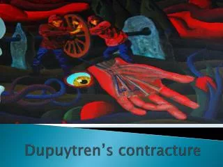 Dupuytren’s contracture