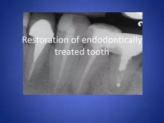 Restoration of endodontically treated tooth