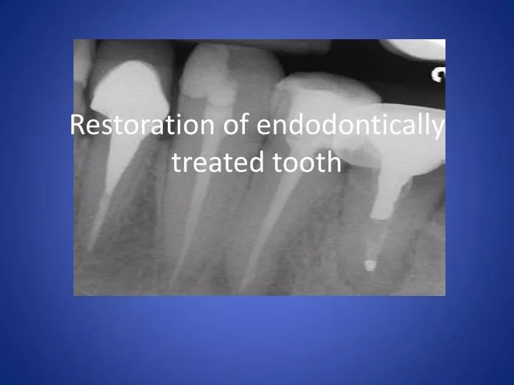 restoration of endodontically treated tooth