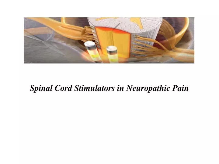 spinal cord stimulators in neuropathic pain