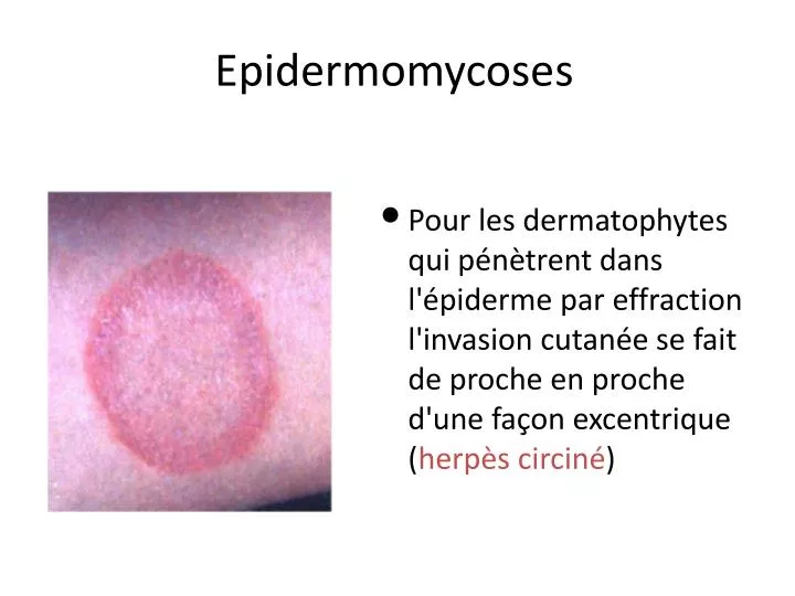 epidermomycoses
