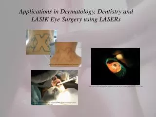 Applications in Dermatology, Dentistry and LASIK Eye Surgery using LASERs