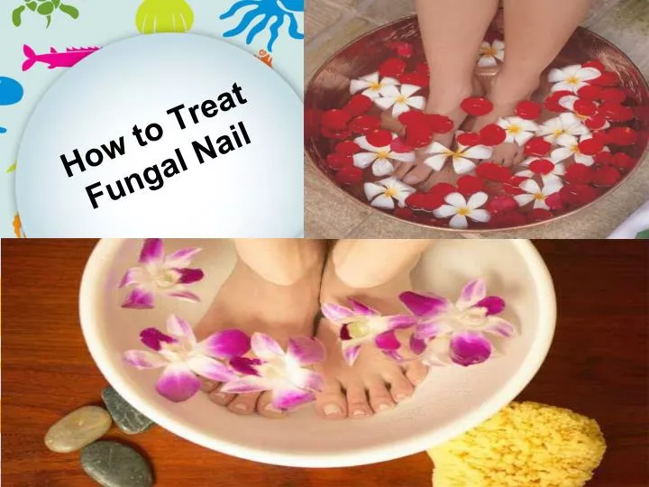 how to treat fungal nail