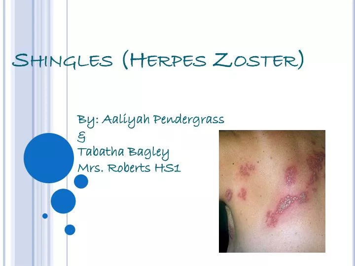 shingles herpes zoster