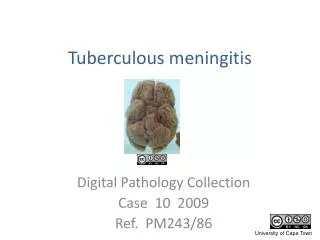 Tuberculous meningitis