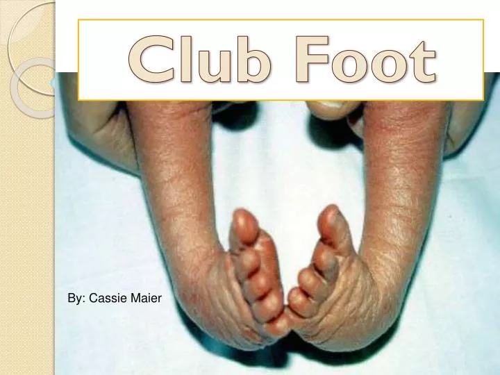 club foot