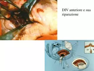 DIV anteriore e sua riparazione