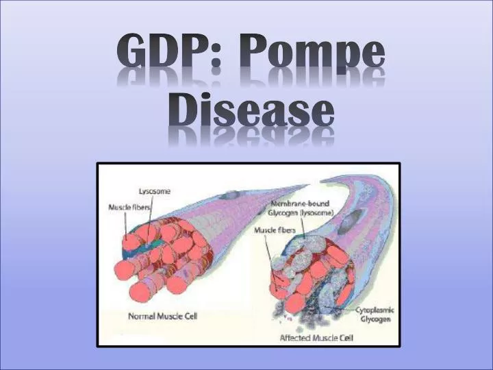 gdp pompe disease