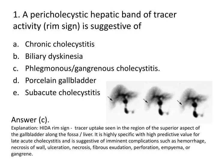 1 a pericholecystic hepatic band of tracer activity rim sign is suggestive of