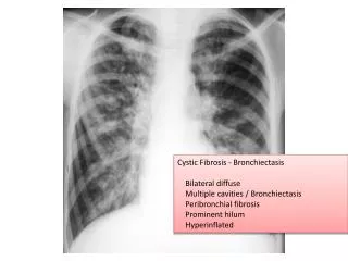 Cystic Fibrosis - Bronchiectasis Bilateral diffuse Multiple cavities / Bronchiectasis