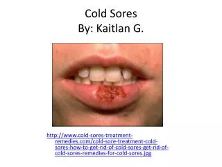 Cold Sores By: Kaitlan G.