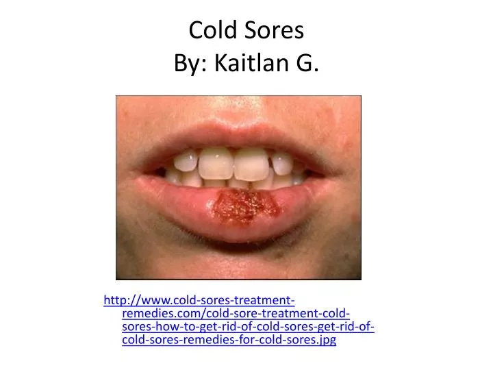 cold sores by kaitlan g