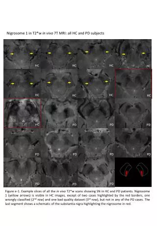 Nigrosome 1 in T2*w in vivo 7T MRI: all HC and PD subjects
