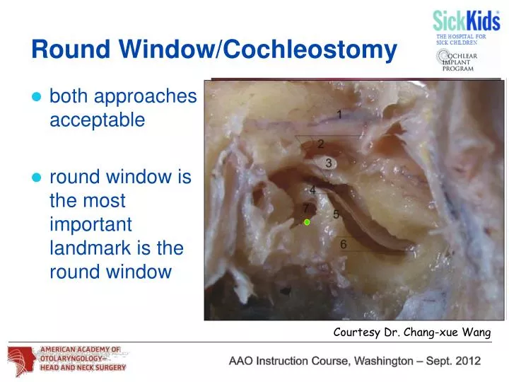 round window cochleostomy