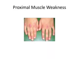 proximal muscle weakness