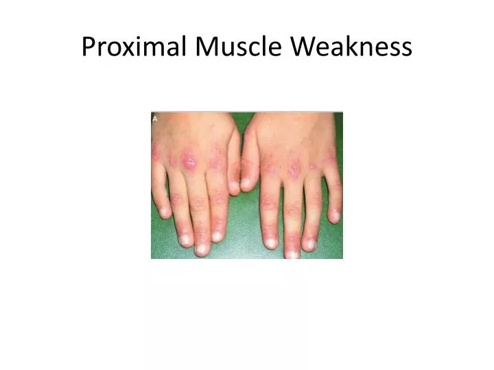 proximal muscle weakness