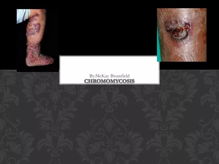 chromomycosis