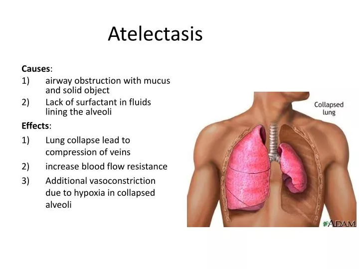 atelectasis alveoli