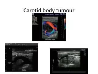 Carotid body tumour