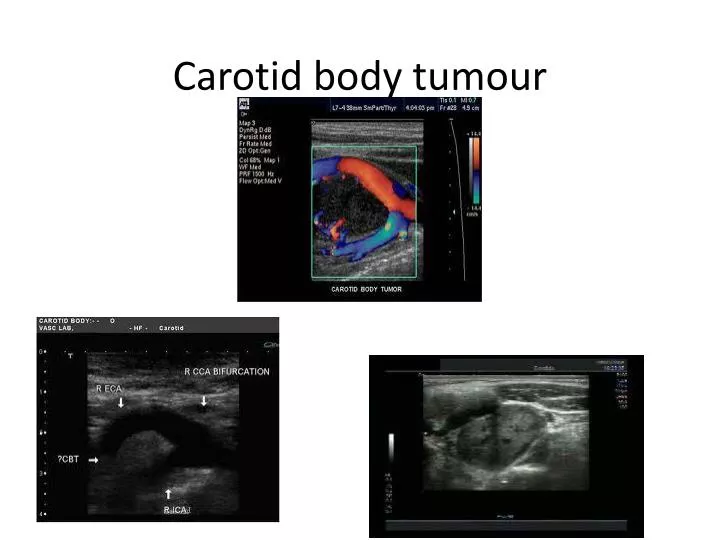 carotid body tumour