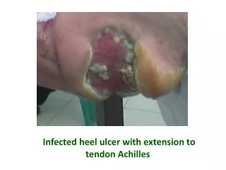 Infected heel ulcer with extension to tendon Achilles