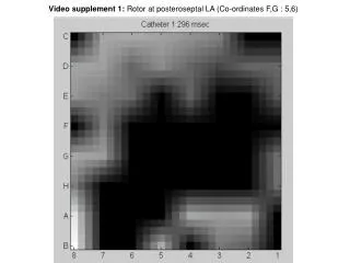 Video supplement 1: Rotor at posteroseptal LA (Co-ordinates F,G : 5,6)