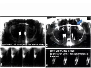 OPG VIEW of JAW BONE(Bone Arch without teeth)