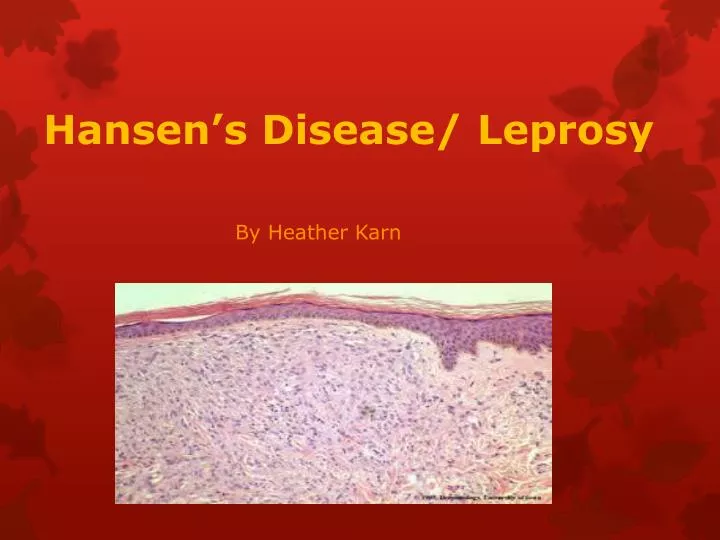 hansen s disease leprosy